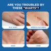 Sumifun Wart Removal Cream 04 Sumifun Wart Removal Cream