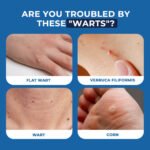 Sumifun Wart Removal Cream - Image 4