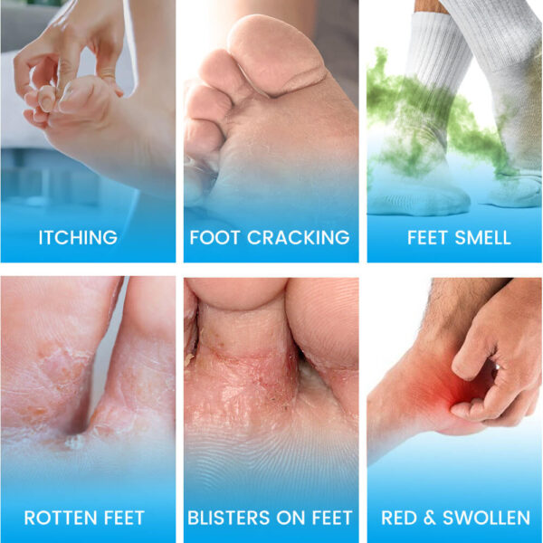 athlete's foot cream