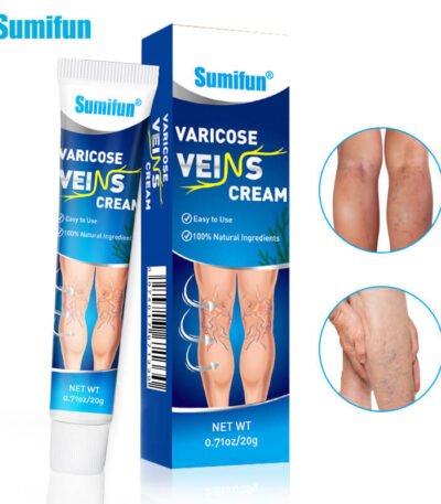 varicose veins cream