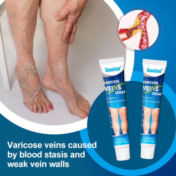 Varicose Veins Cream