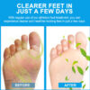 cream for athlete's foot