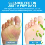 cream for athlete's foot