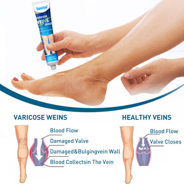 cream for varicose veins