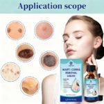 REVA Wart Removal Treatment - Image 5