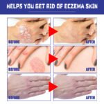 South Moon Psoriasis Relief Spray - Image 4