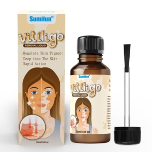 Sumifun Vitiligo Removal Liquid-1 Sumifun Vitiligo Removal Liquid