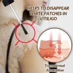 Sumifun Vitiligo Removal Liquid - Image 2