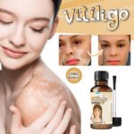 Sumifun Vitiligo Removal Liquid - Image 4