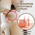 Sumifun Vitiligo Removal Spray - Image 2
