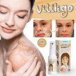 Sumifun Vitiligo Removal Spray - Image 3