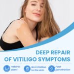 Sumifun Vitiligo Treatment Spray - Image 3