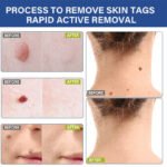 Sumifun Wart Remover Pen - Image 3