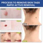 Sumifun Wart Remover Pen - Image 3