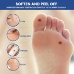 Sumifun Wart Remover Pen - Image 4