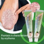 ZULANGZHONG Dermophyte Clearing Cream - Image 2